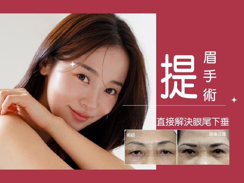 提眉手術