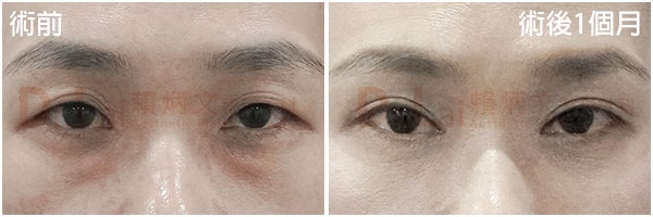 割雙皮案例+眼頭+眼袋內開
