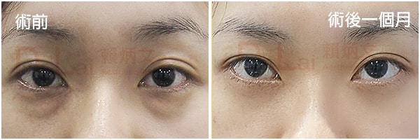 眼袋內開+脂肪移位淚溝