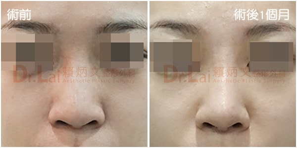 隆鼻手術案例