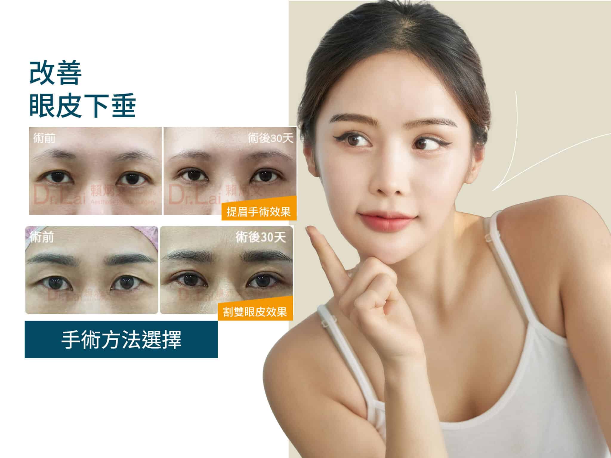 改善眼皮下垂，割雙眼皮還是提眉手術_工作區域 1 複本