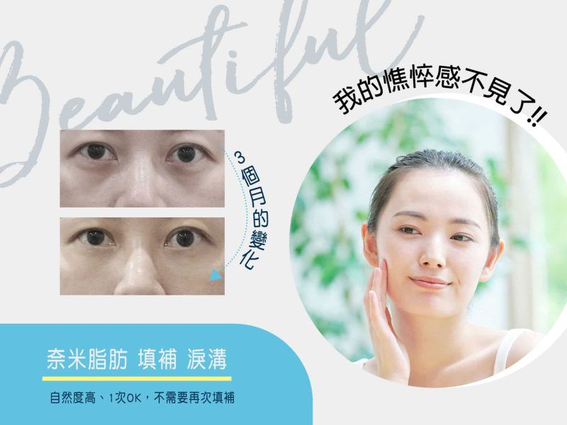 奈米脂肪補淚溝