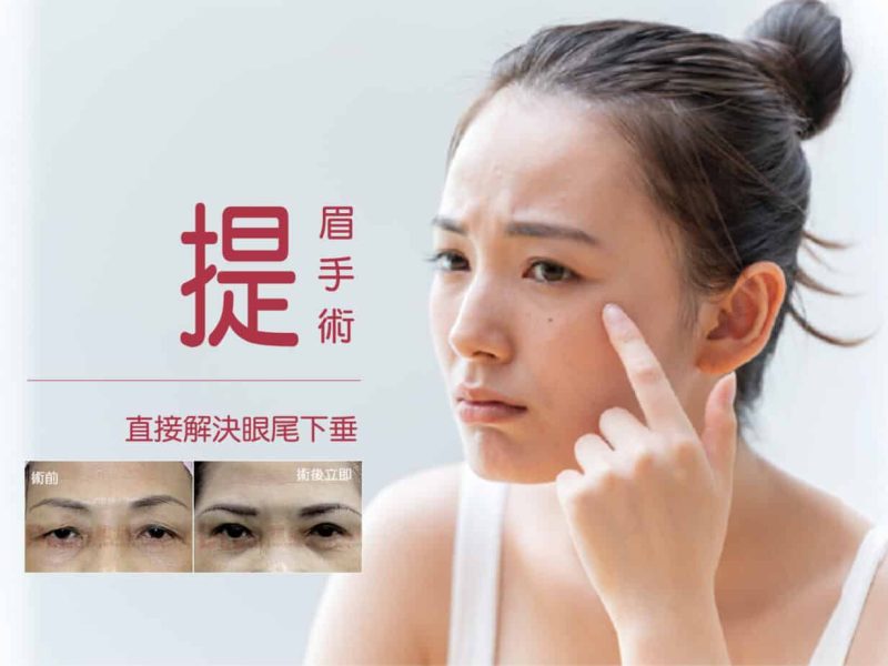 眼皮下垂，提眉手術與額頭拉皮如何選擇