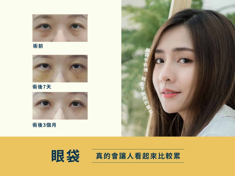 眼袋手術